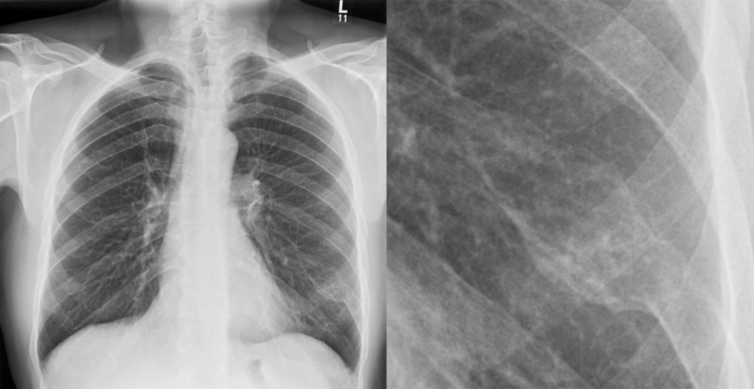 骨纤维异常增殖症是个什么病？影像表现原来是这样的……-1