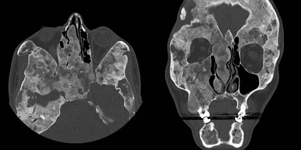 骨纤维异常增殖症是个什么病？影像表现原来是这样的……-5