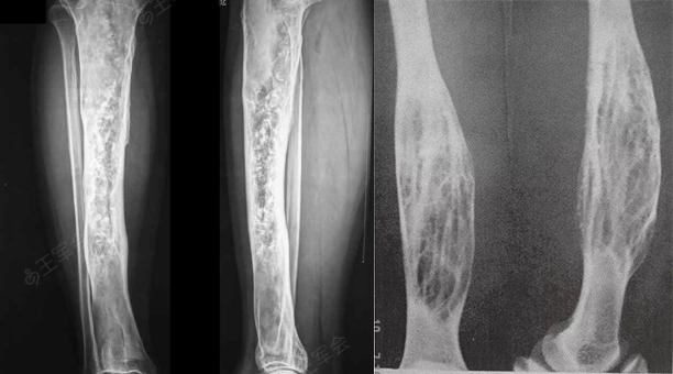 骨纤维异常增殖症是个什么病？影像表现原来是这样的……-8