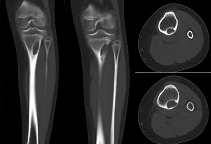 骨纤维异常增殖症是个什么病？影像表现原来是这样的……-13