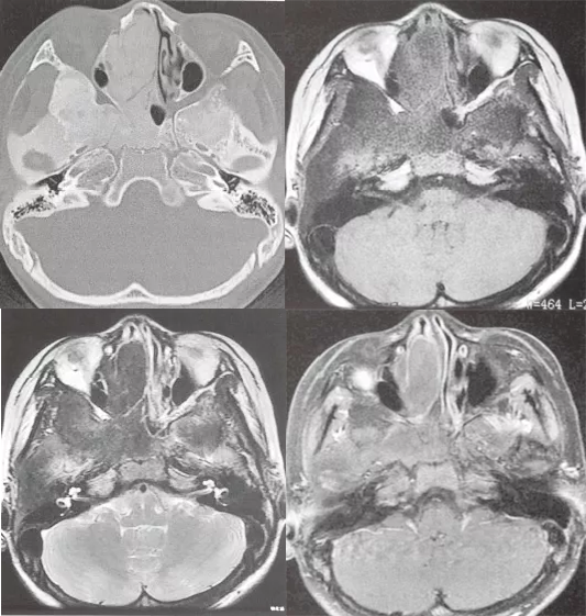 骨纤维异常增殖症是个什么病？影像表现原来是这样的……-4