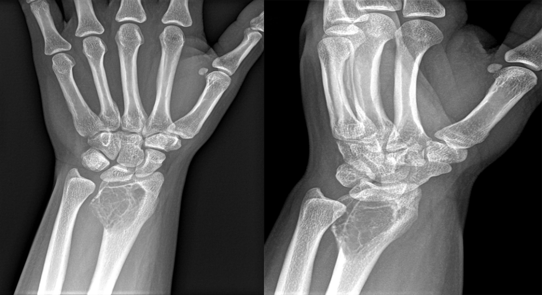 骨纤维异常增殖症是个什么病？影像表现原来是这样的……-11