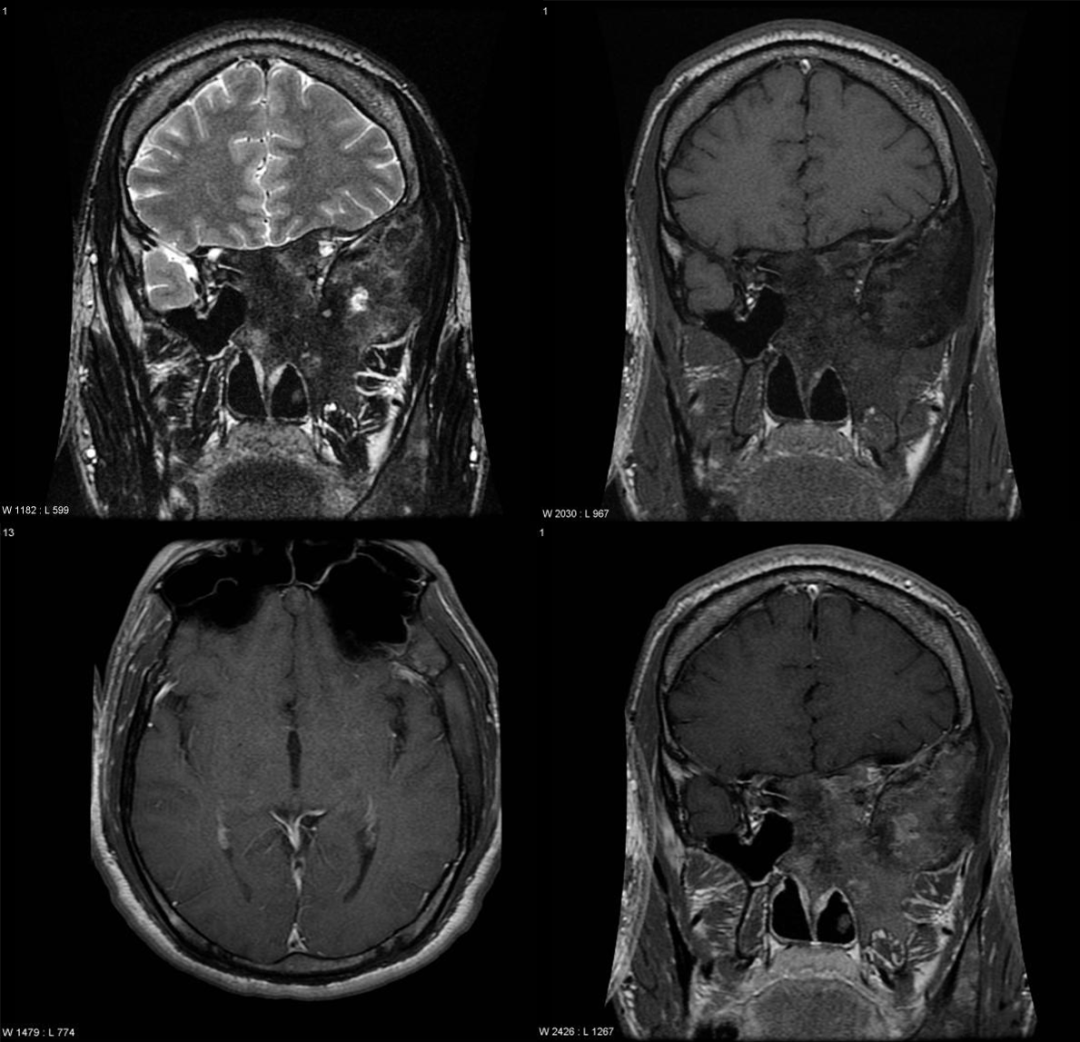 骨纤维异常增殖症是个什么病？影像表现原来是这样的……-9