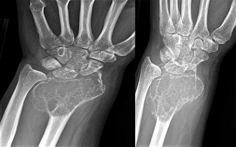 骨纤维异常增殖症是个什么病？影像表现原来是这样的……-12