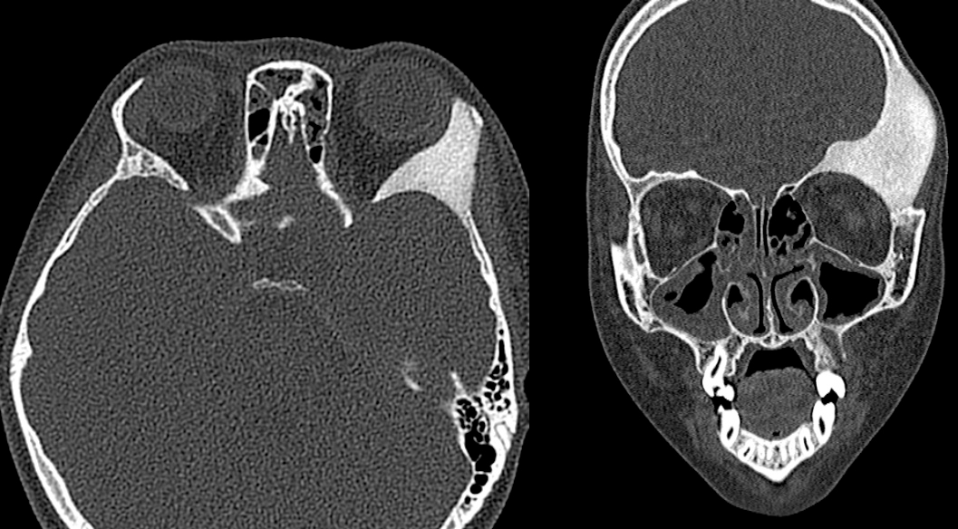 骨纤维异常增殖症是个什么病？影像表现原来是这样的……-7