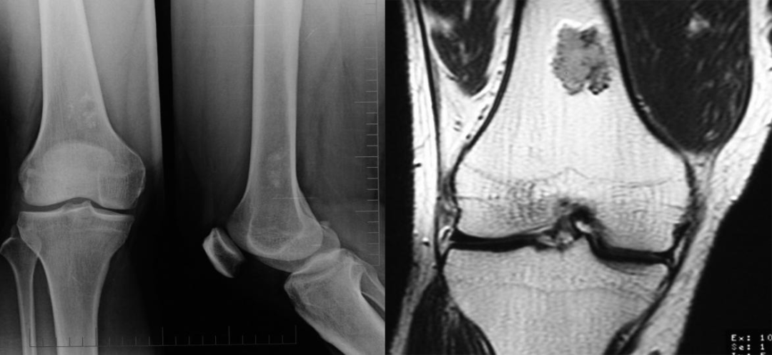 骨纤维异常增殖症是个什么病？影像表现原来是这样的……-14