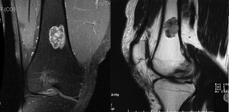 骨纤维异常增殖症是个什么病？影像表现原来是这样的……-15
