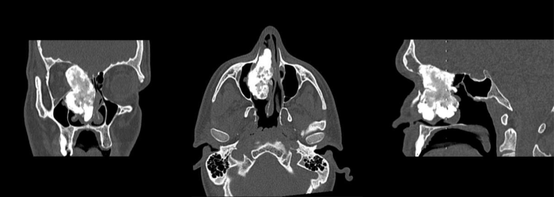 骨纤维异常增殖症是个什么病？影像表现原来是这样的……-6