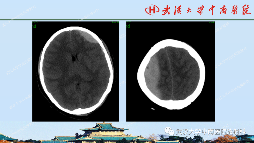 【PPT】脑外伤影像学诊断-8