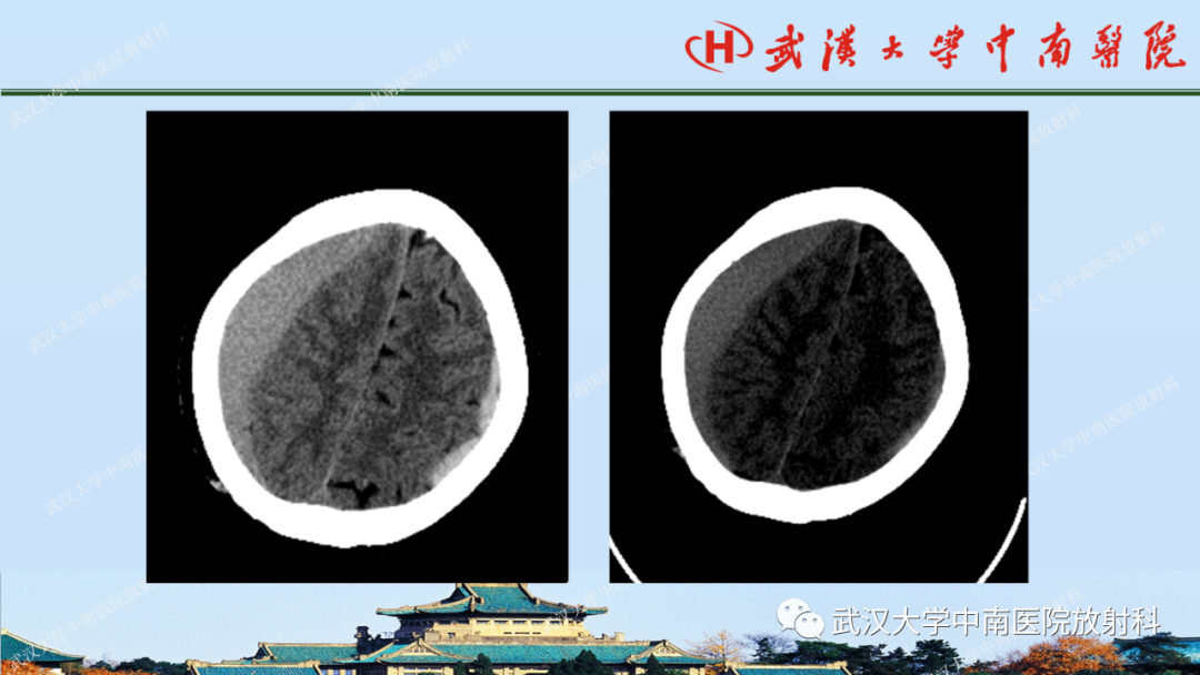 【PPT】脑外伤影像学诊断-10