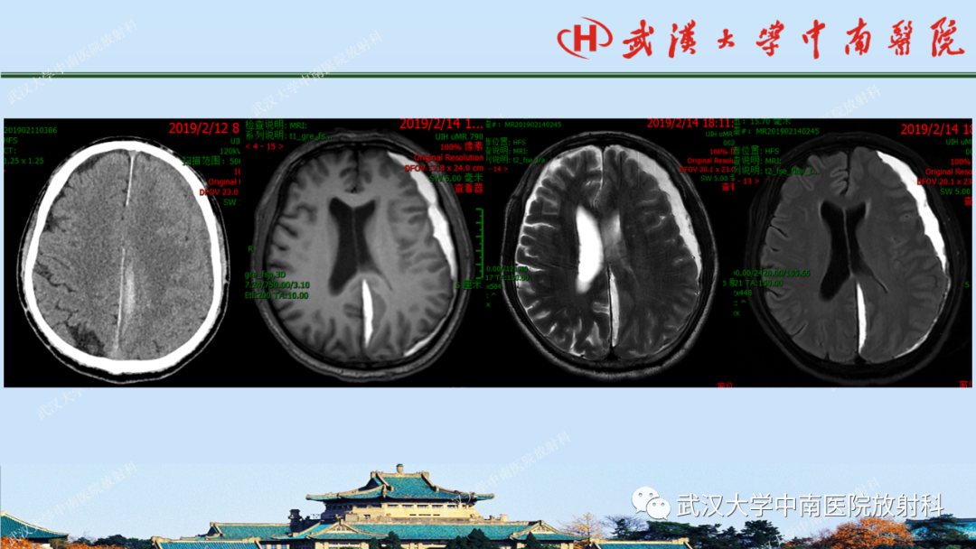 【PPT】脑外伤影像学诊断-11