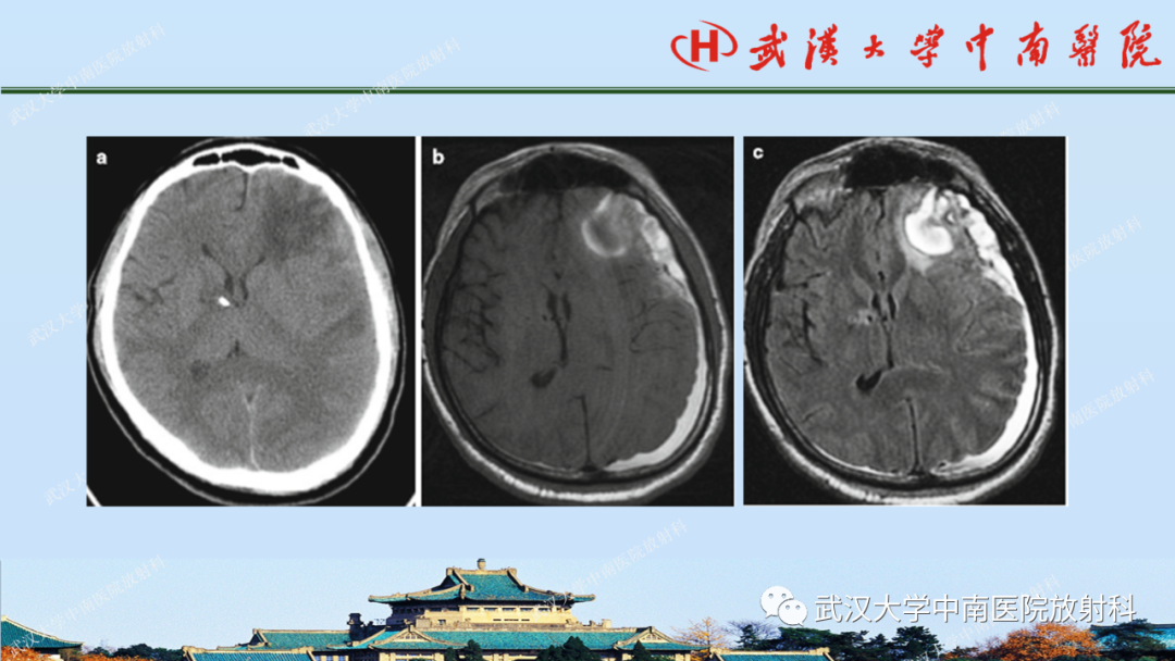 【PPT】脑外伤影像学诊断-12