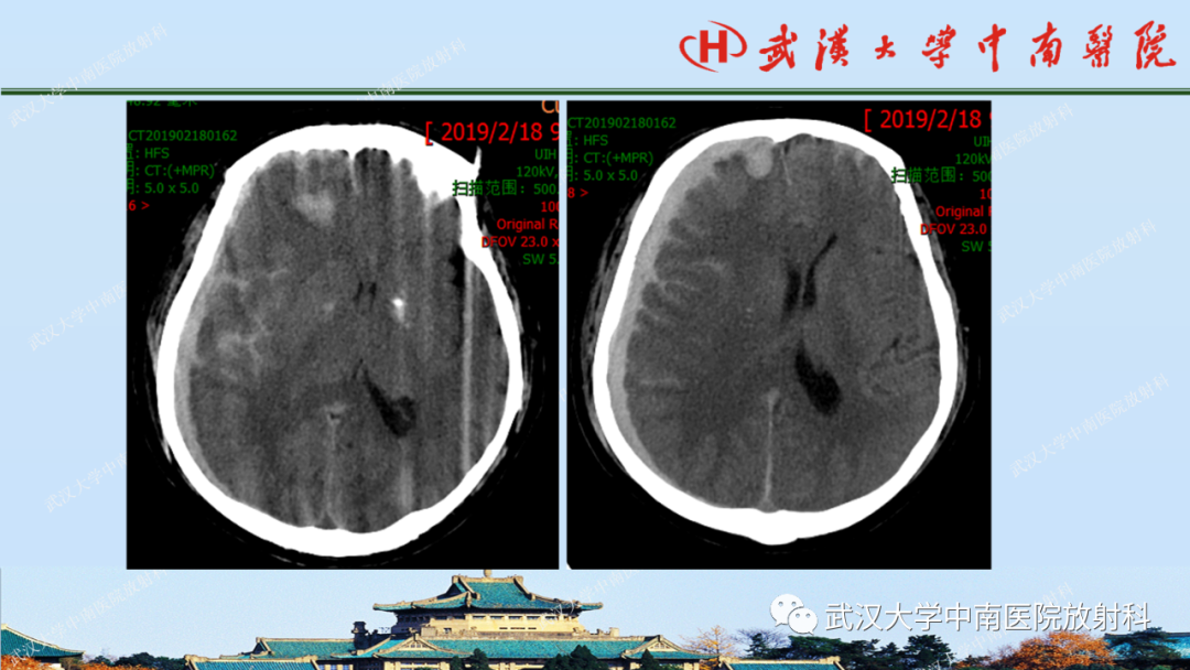 【PPT】脑外伤影像学诊断-14