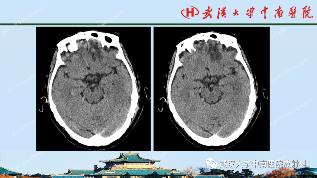【PPT】脑外伤影像学诊断-16