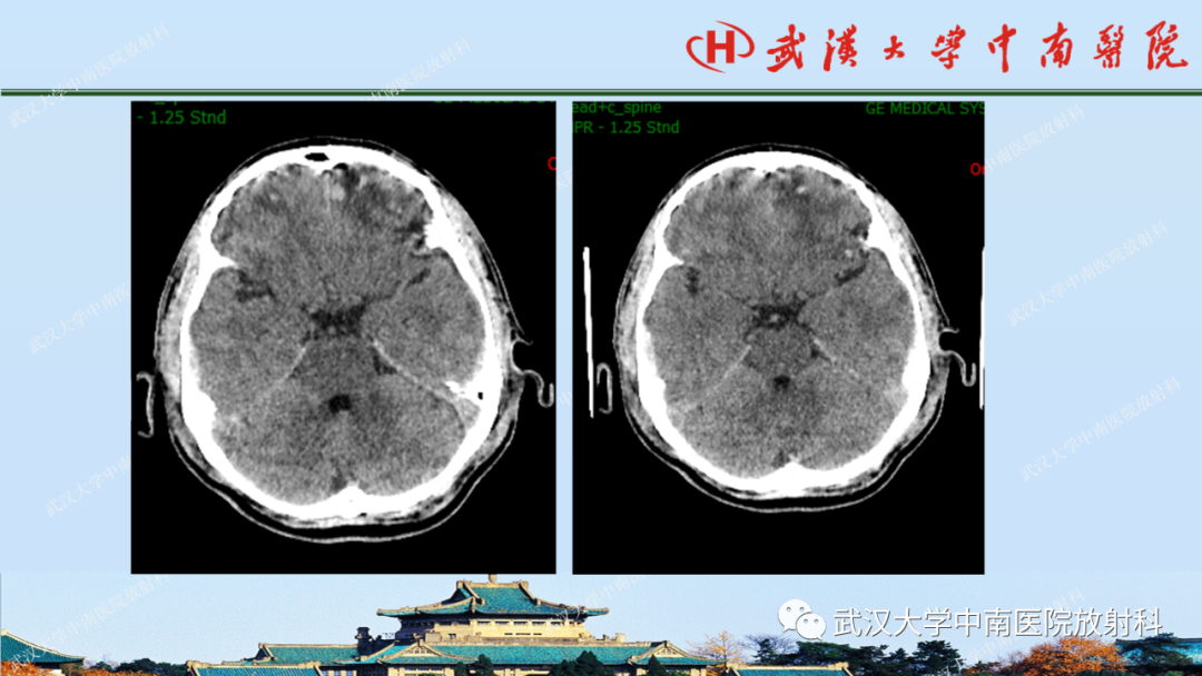 【PPT】脑外伤影像学诊断-17
