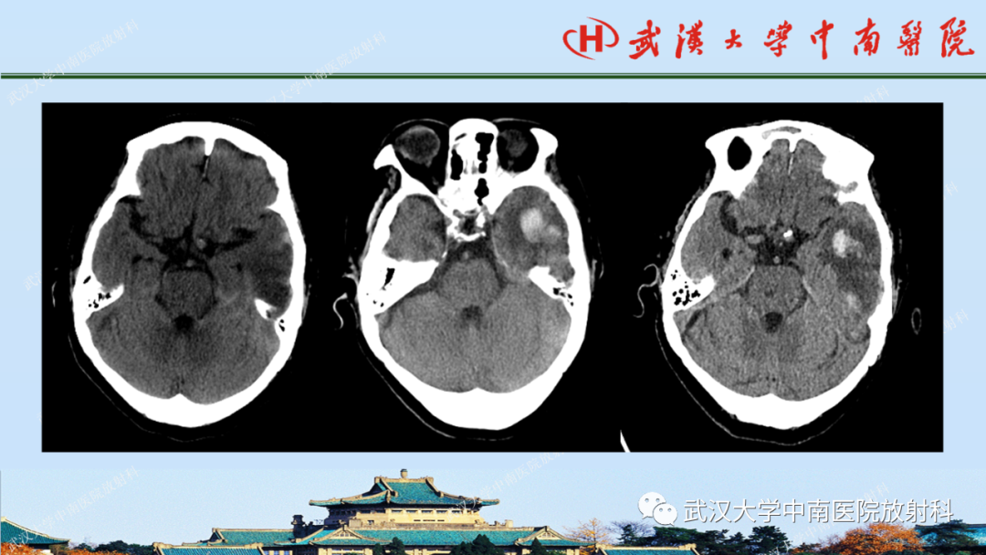 【PPT】脑外伤影像学诊断-18