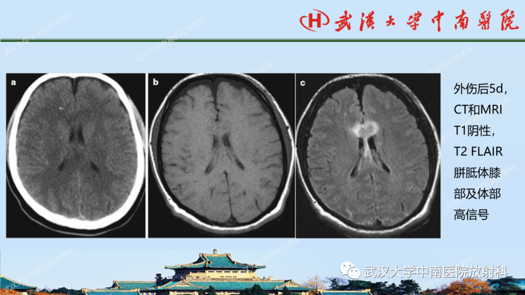【PPT】脑外伤影像学诊断-21