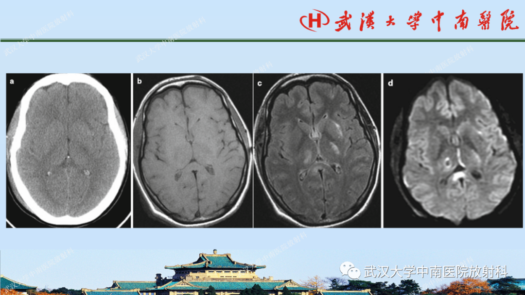 【PPT】脑外伤影像学诊断-22
