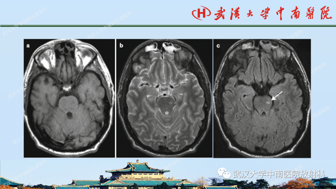 【PPT】脑外伤影像学诊断-23