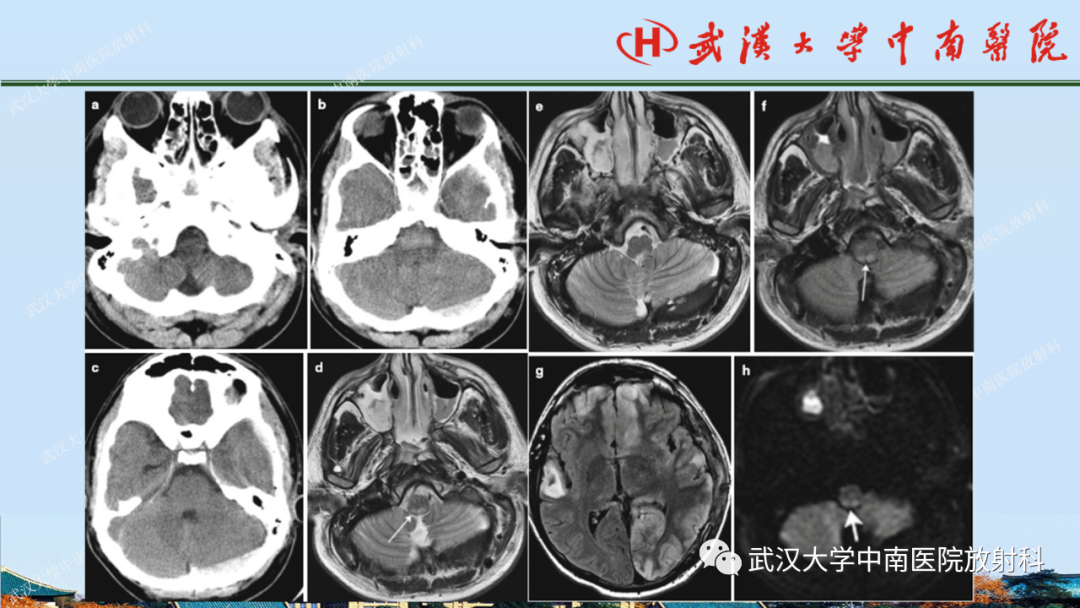 【PPT】脑外伤影像学诊断-24