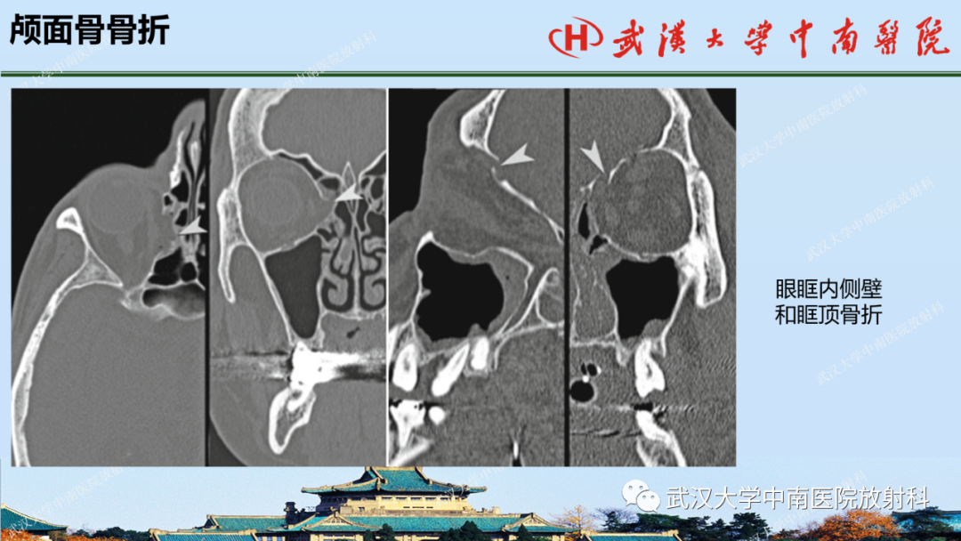 【PPT】脑外伤影像学诊断-27