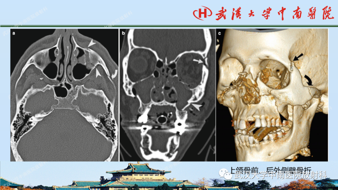 【PPT】脑外伤影像学诊断-28