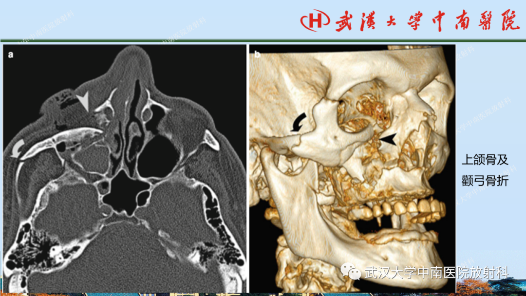 【PPT】脑外伤影像学诊断-29