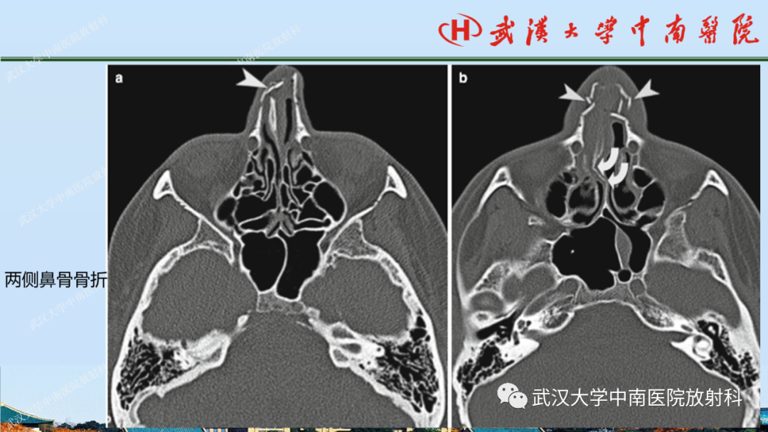 【PPT】脑外伤影像学诊断-30