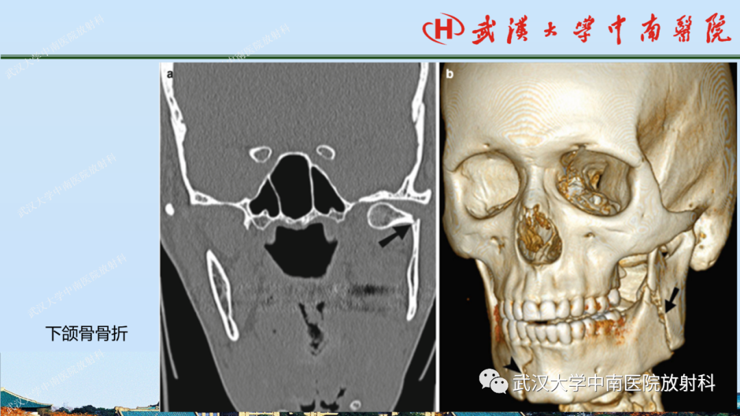 【PPT】脑外伤影像学诊断-31
