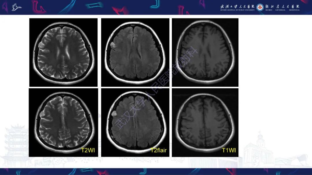 【PPT】脑多形性黄色星形细胞瘤影像诊断-3