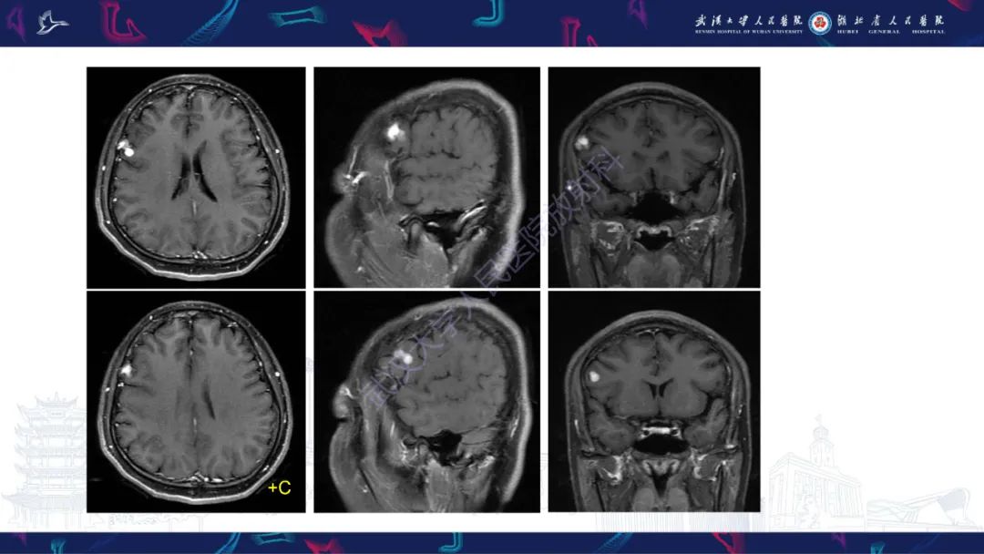 【PPT】脑多形性黄色星形细胞瘤影像诊断-4