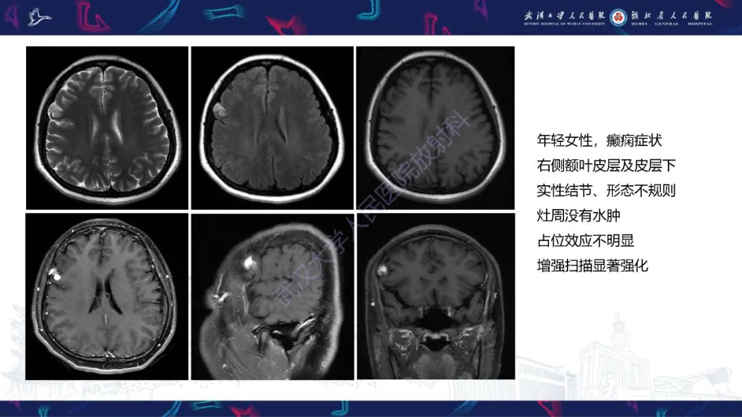 【PPT】脑多形性黄色星形细胞瘤影像诊断-6
