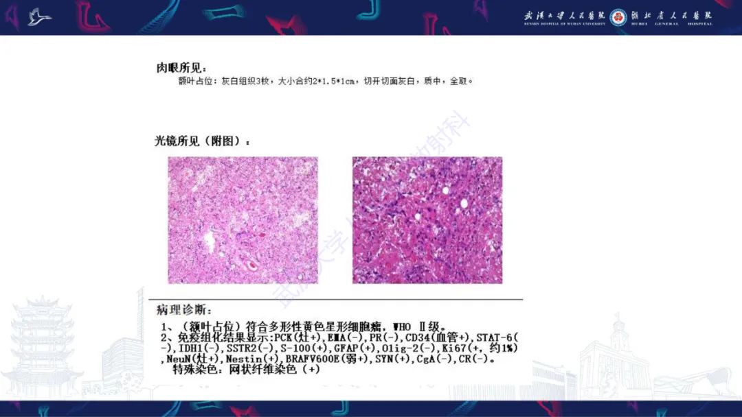 【PPT】脑多形性黄色星形细胞瘤影像诊断-8