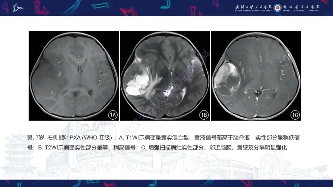 【PPT】脑多形性黄色星形细胞瘤影像诊断-16