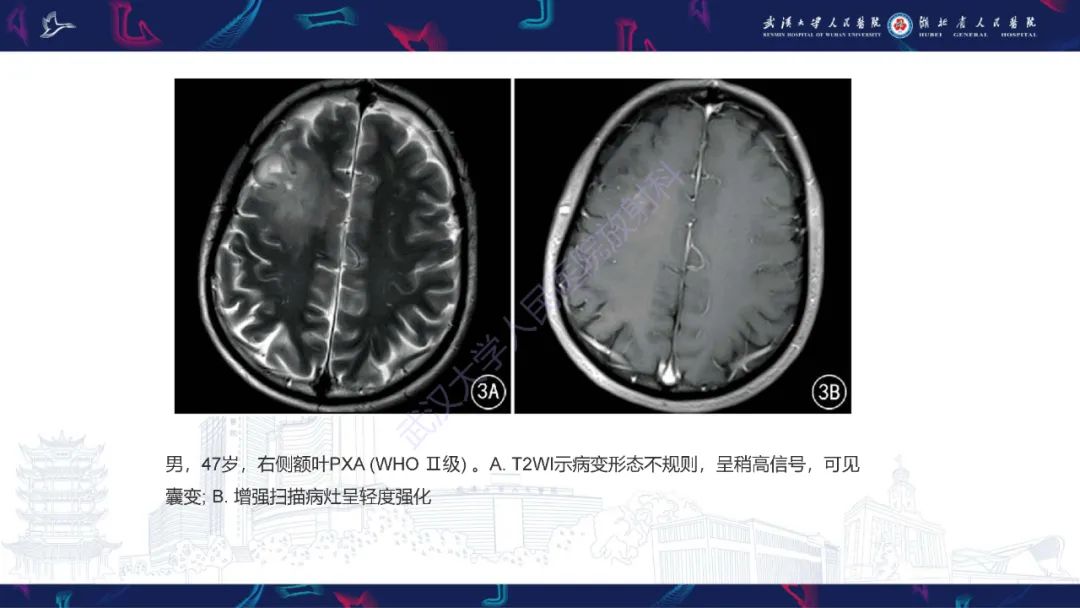 【PPT】脑多形性黄色星形细胞瘤影像诊断-17