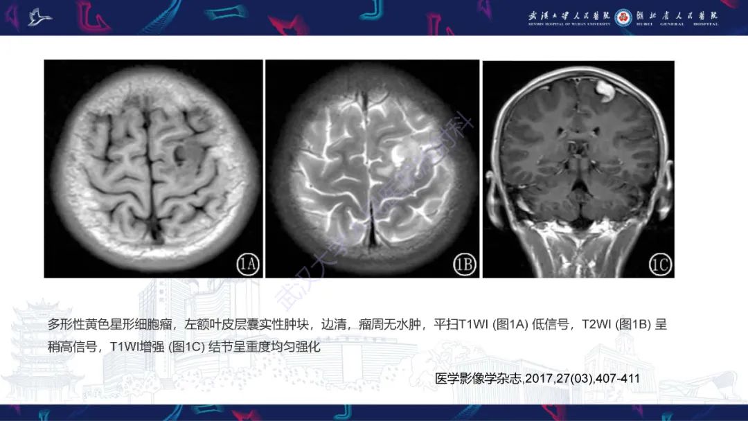 【PPT】脑多形性黄色星形细胞瘤影像诊断-18