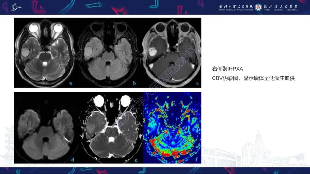 【PPT】脑多形性黄色星形细胞瘤影像诊断-19