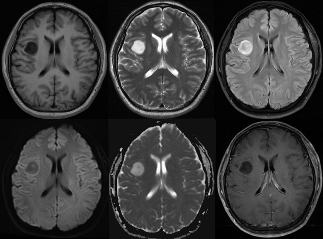 T2-FLAIR 错配征——这个影像征象很特异-1