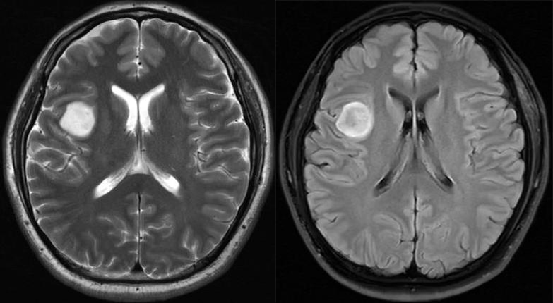T2-FLAIR 错配征——这个影像征象很特异-3