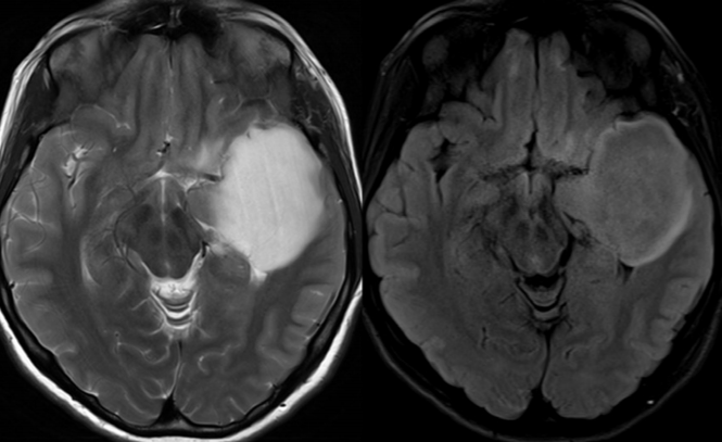 T2-FLAIR 错配征——这个影像征象很特异-5