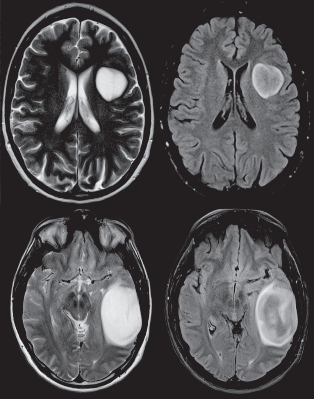 T2-FLAIR 错配征——这个影像征象很特异-4