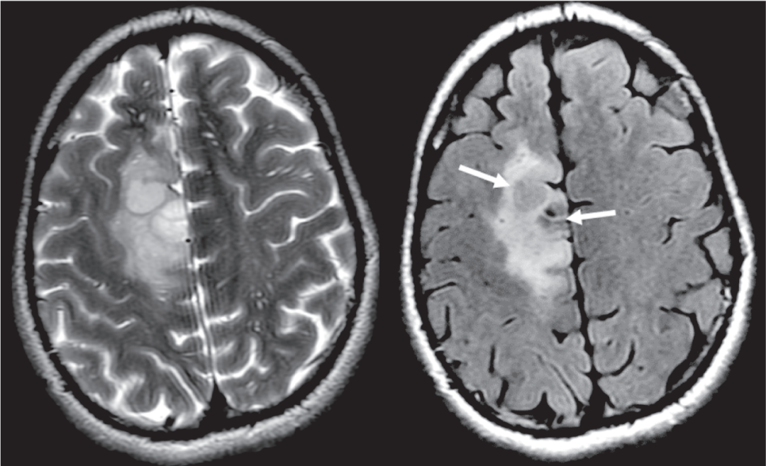 T2-FLAIR 错配征——这个影像征象很特异-6