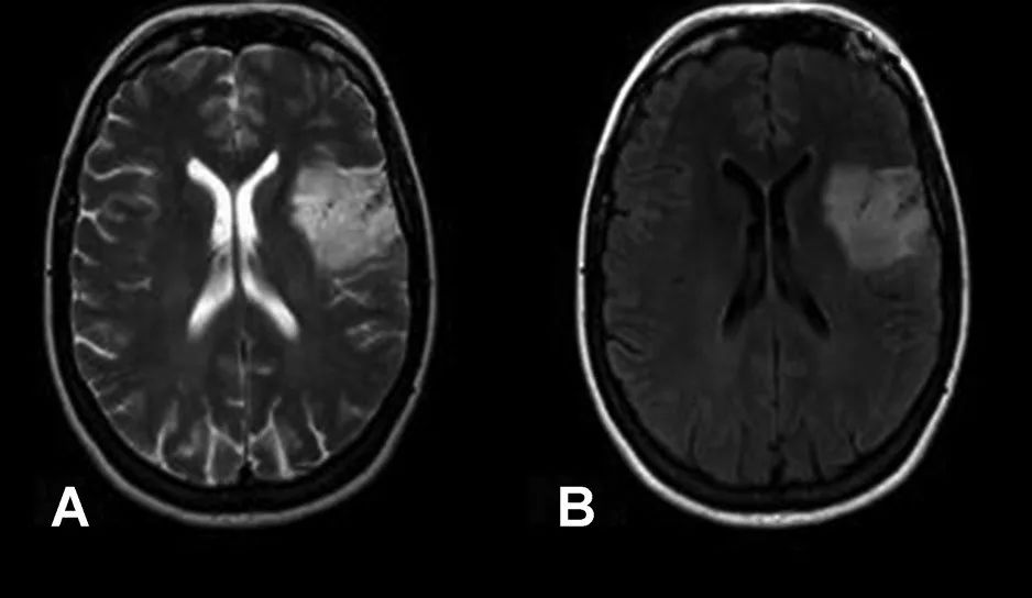 T2-FLAIR 错配征——这个影像征象很特异-7