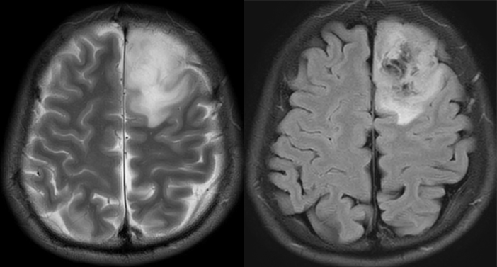 T2-FLAIR 错配征——这个影像征象很特异-9