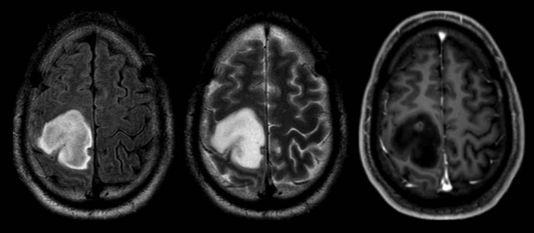 T2-FLAIR 错配征——这个影像征象很特异-10