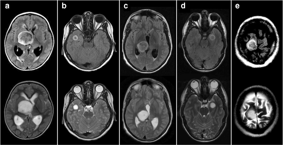 T2-FLAIR 错配征——这个影像征象很特异-12