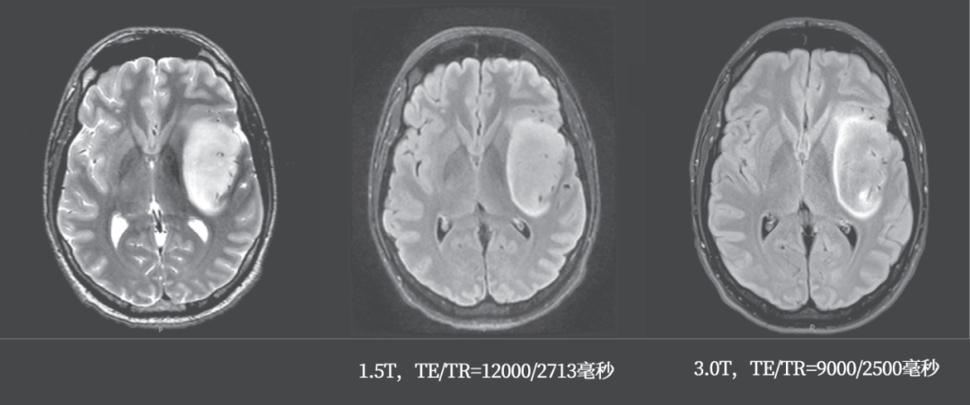 T2-FLAIR 错配征——这个影像征象很特异-11