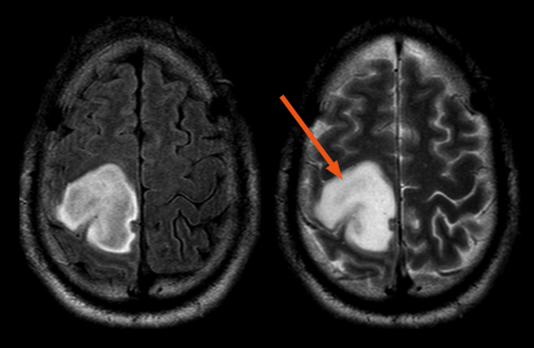 T2-FLAIR 错配征——这个影像征象很特异-13