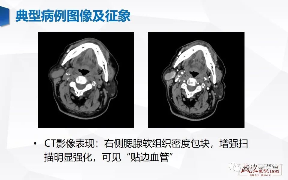 【病例】腮腺肿瘤—腮腺腺淋巴瘤1例CT及MR-4