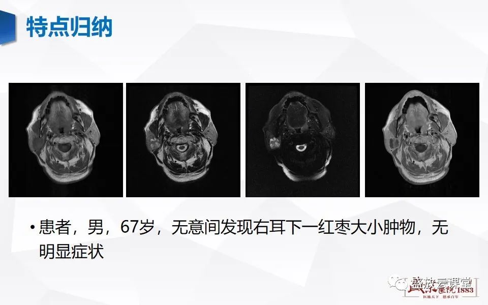 【病例】腮腺肿瘤—腮腺腺淋巴瘤1例CT及MR-11